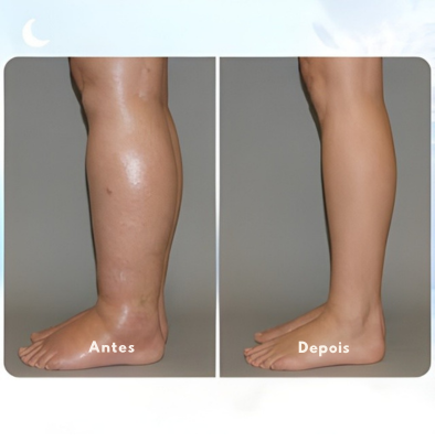 Vitaflex - Trate o Inchaço Nas Pernas Em Casa + Frete Grátis